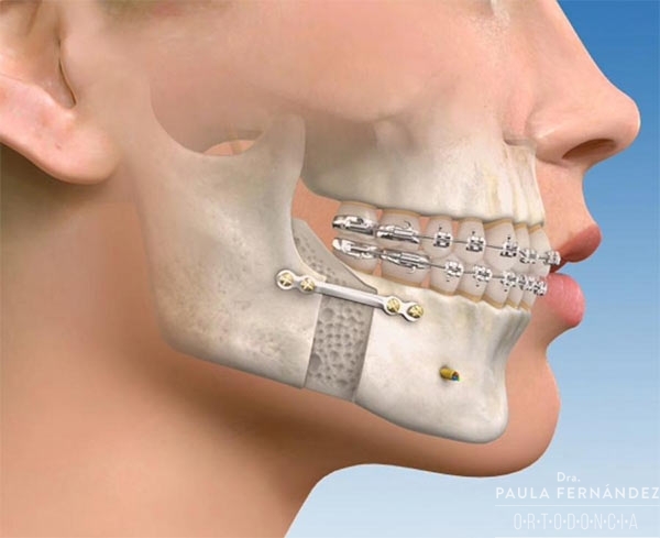 Ortodoncia y Cirugía