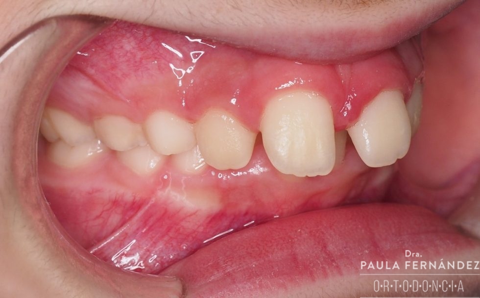 Dientes superiores hacia afuera Paula Fernández Riveiro