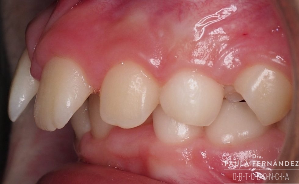 Dientes superiores hacia afuera Paula Fernández Riveiro