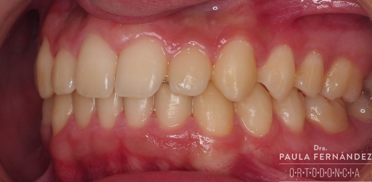 Dientes superiores hacia afuera Paula Fernández Riveiro